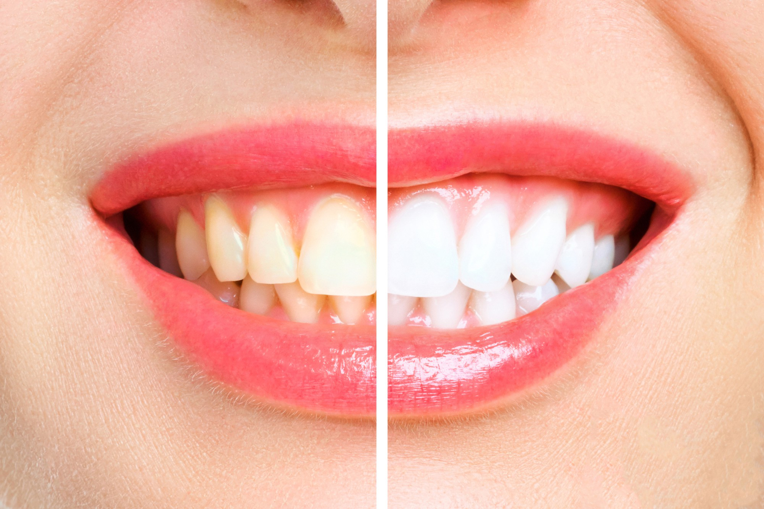 Sbiancamento Dentale: Verità e Falsi Miti da Conoscere